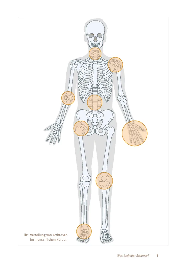 Abbildung 10 von Expertenwissen: Arthrose